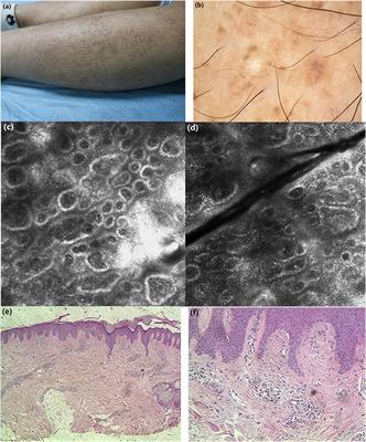 Case Report: Diagnosis of Primary Cutaneous Amyloidosis Using Dermoscopy and Reflectance Confocal Microscopy